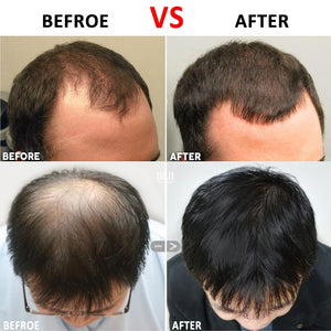 Trajtimi kundër humbjes së flokëve
